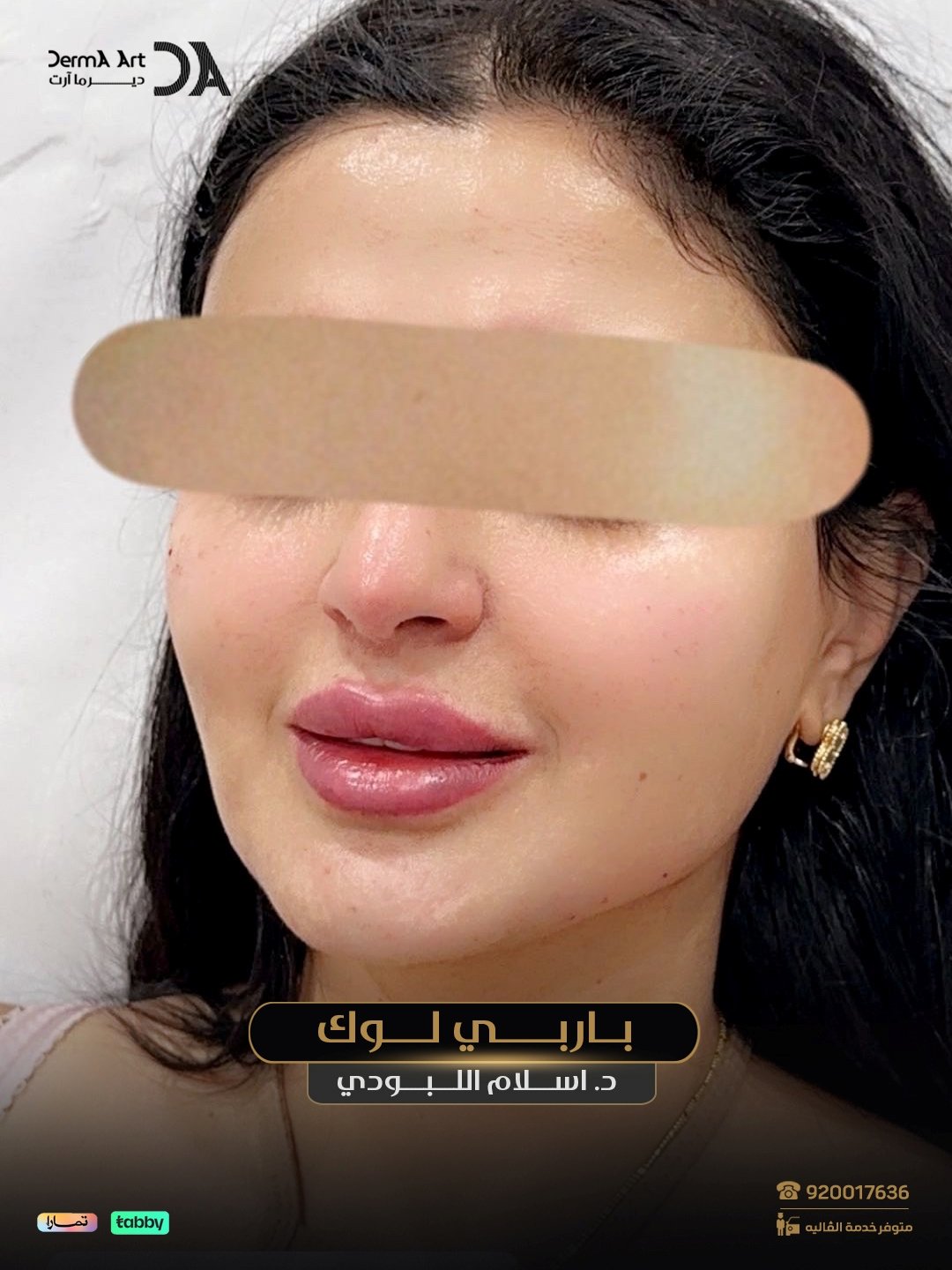 حالة قبل وبعد مع د. إسلام اللبودي - الحالة 04
