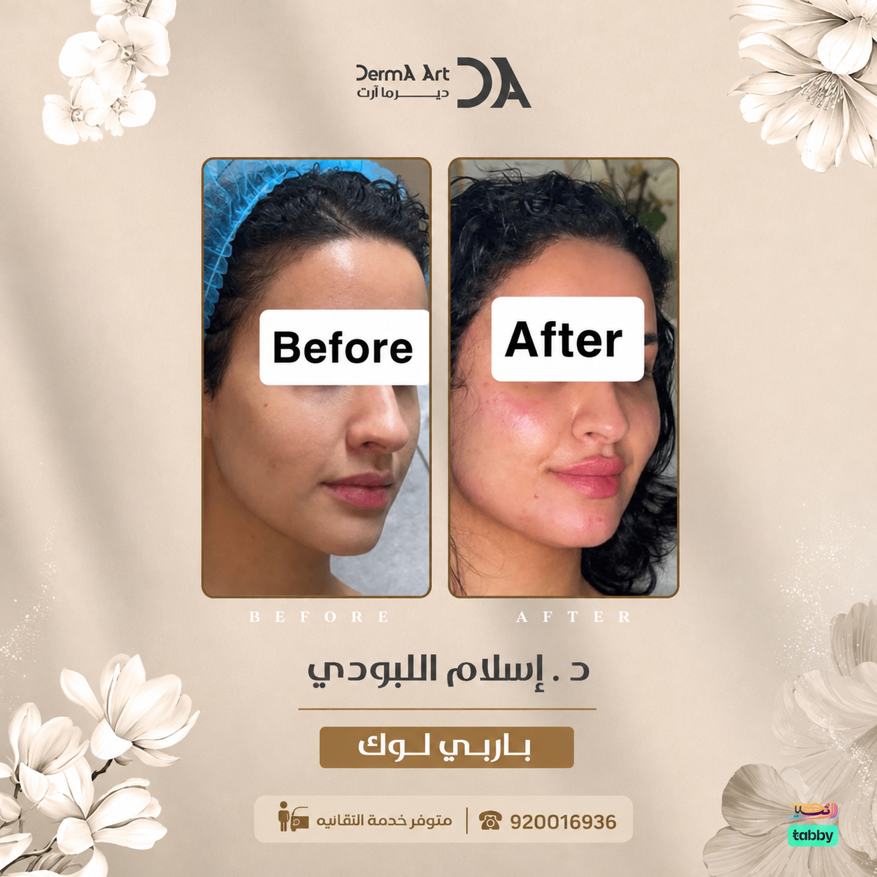 الفرق بين السكن بوستر والفيلر