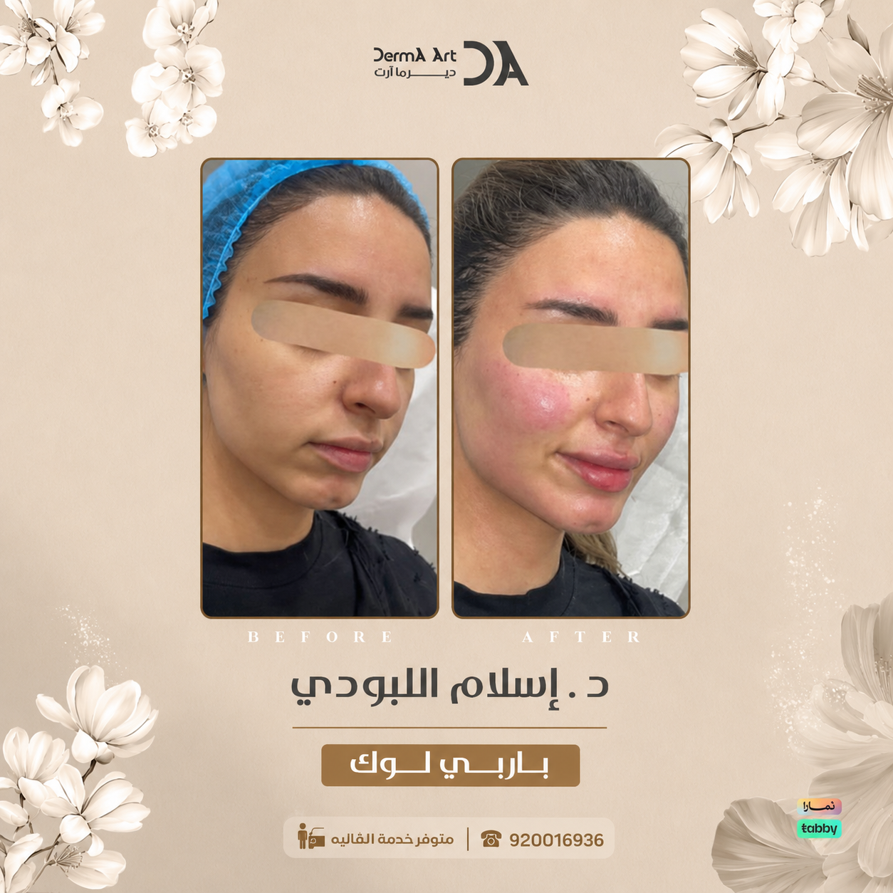 عروض فيلر بالرياض