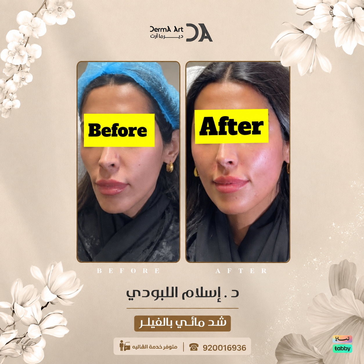 تكبير الشفايف أم تحديدها بالفيلر