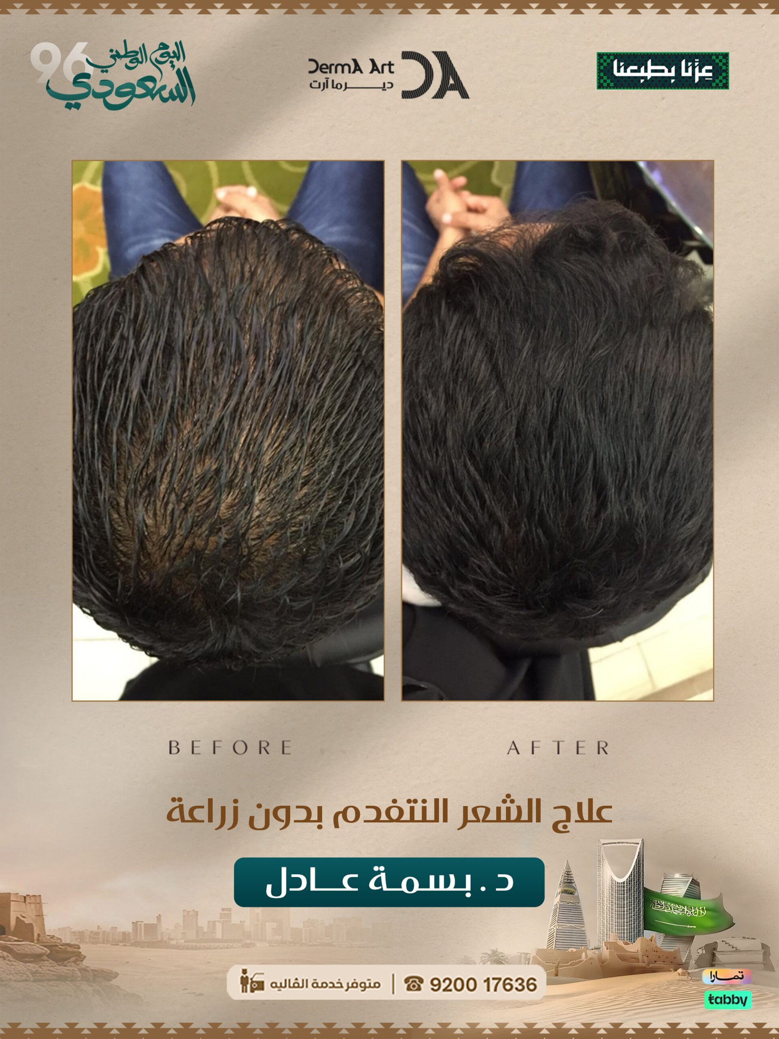 حالة قبل وبعد مع الدكتورة بسمة عادل - الحالة 07