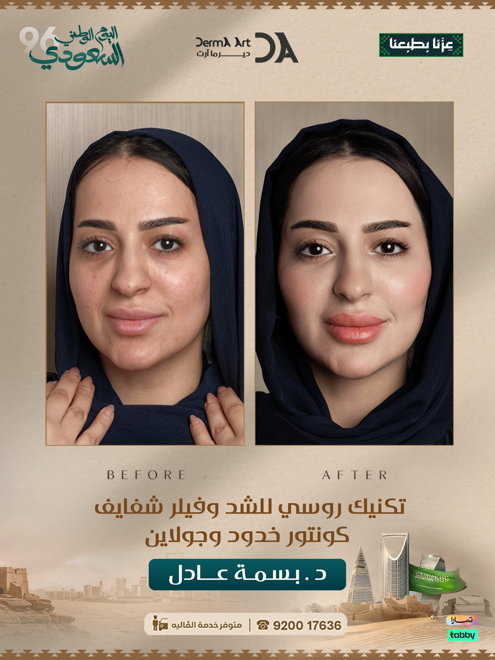 حالة قبل وبعد مع الدكتورة بسمة عادل - الحالة 01